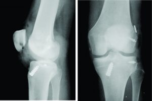 Imagem da notícia - Equipe da FHAJ realiza cirurgia ortopédica inédita na rede pública de saúde